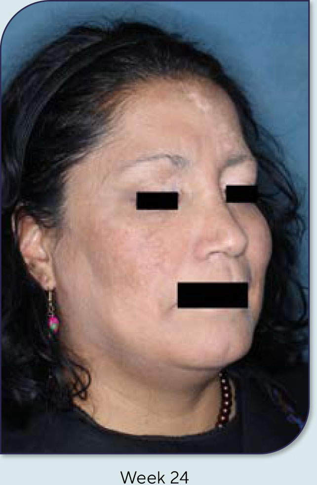 F-VASI75 example two - Week 24